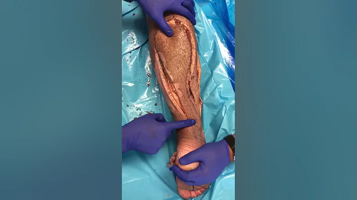 Reverse Sural Flap Modification (Dr. Edgardo Rodri...
