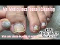 👣Short'n Sweet - Mr. Meticulous Satisfying Impacted Toenail Cleaning👣