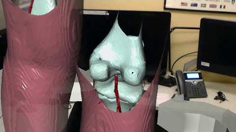 Augmented Reality Bone Tumor model with the RadHA app!