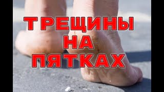 ВСЕГО ДВА ИНГРЕДИЕНТА И ПЯТКИ КАК У МЛАДЕНЦА!!!ОТ ТРЕЩИН и следа не останется.РЕЦЕПТ