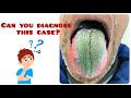 Hairy Tongue | Can you diagnose this case?