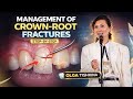 Crown-Root Fractures: Treatment Strategies (Step-by-Step Cases) by OLGA TISHKINA &amp; NEW ICEBERG TEAM