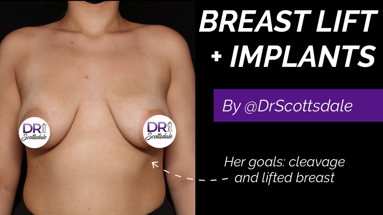 Breast Implant Revision In Scottsdale AZ