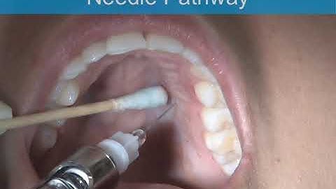 VTS 10 1 Techniques for successful Local anesthesia AMSA
