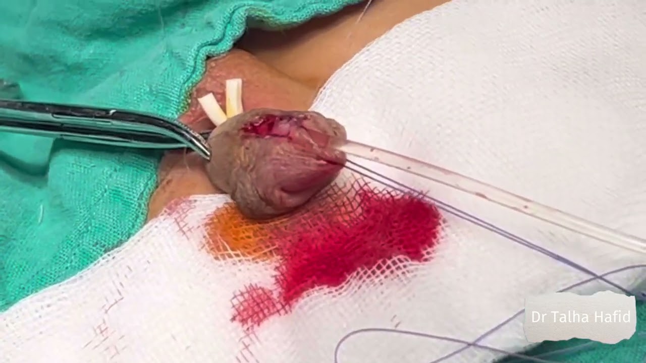 Cure chirurgicale d’un hypospadias antérieur (Technique de Duplay Snodgrass) : Dr Talha Hafid