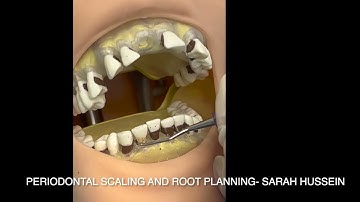 periodontal scaling and root planning by sarah hussein