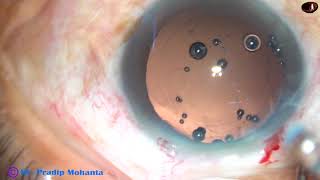 How to divide a very soft cataract.. -Dr Pradip Mohanta, 10/9/2018 screenshot 2