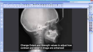Using CLARIFY -- new image enhancement filter in Planmeca Romexis
