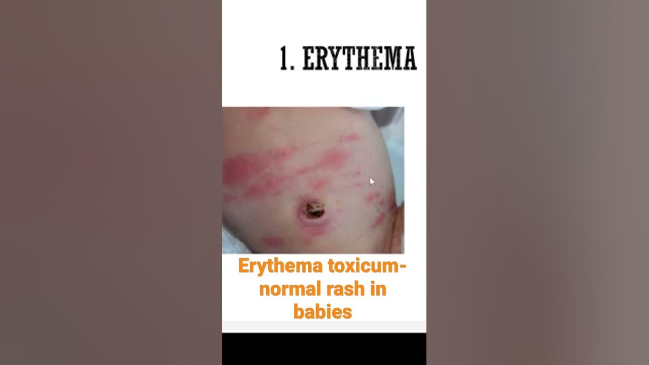 what-is-this-red-rash-on-my-newborn-baby-erythema-toxicum-normal-rash