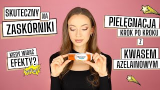 Skinoren na ZASKÓRNIKI - jak go UŻYWAĆ 😯Kwas AZELAINOWY w pielęgnacji krok po kroku🌸