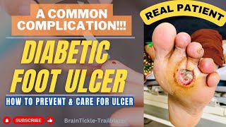 Diabetic Foot Ulcer | Types of Ulcer | Prevention and Care At Home