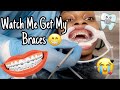 Getting My Braces | Jazmin3 ari3l