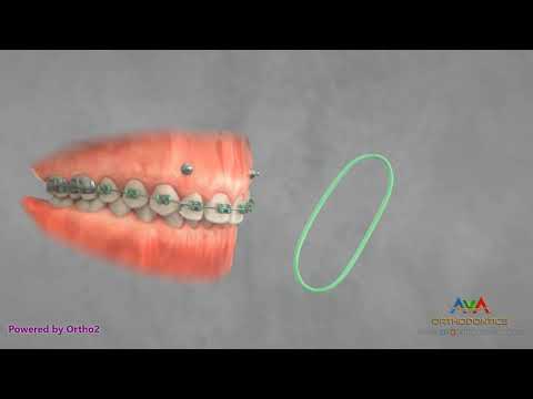 Orthodontic Treatment for Gummy Smile - TAD and Elastics