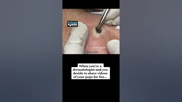 What a FUN Pop! #drpimplepopper