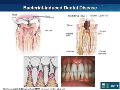 Basic Oral Health for HIV Patients