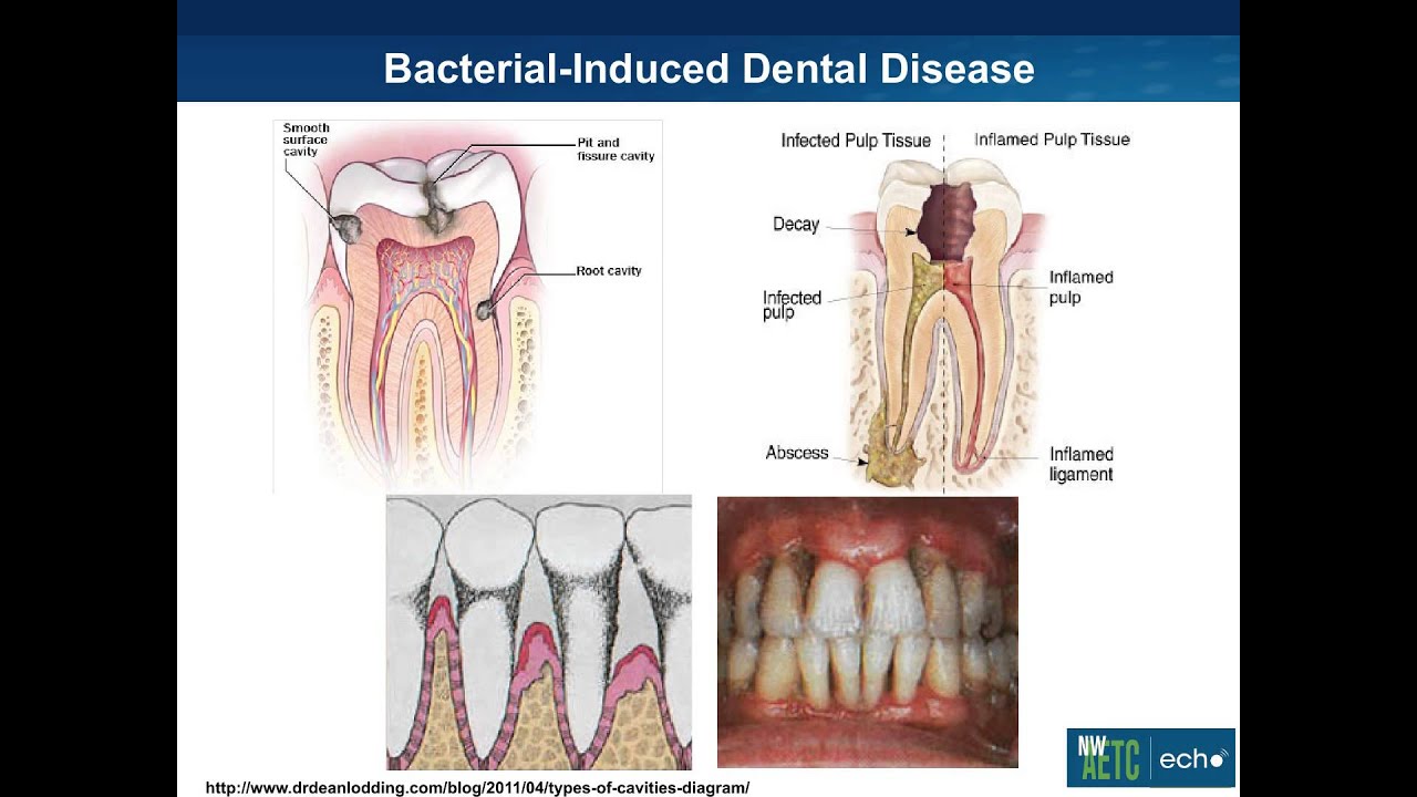 Basic Oral Health For Hiv Patients Youtube