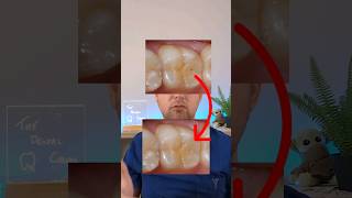 Can you reverse Cavities? #shorts