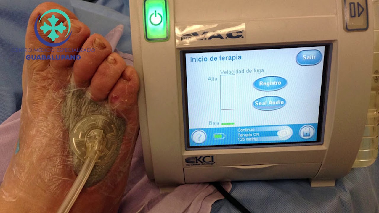 Beneficios de la Terapia VAC YouTube