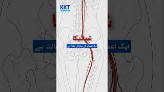 Sciatica #orthopedics #sciaticpain #sciaticarecovery #painrelief