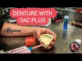 Making denture with oac plug oroantral communication waxbae dentures oac