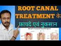 Root canal treatment के फायदे एवं नुकसान क्या होतें हैं ? Benefits of root canal treatment ||