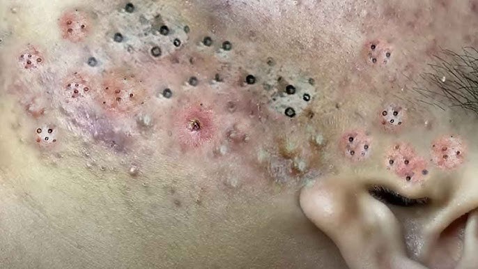 Big Cystic Acne Blackheads Extraction Blackheads & Milia, Whiteheads  Removal Pimple Popping # 3661 - YouTube