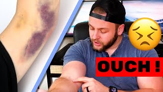 Famous Does Donating Plasma Give You a Permanent Scar? | Permanent Scarring From Donating Plasma Net Worth