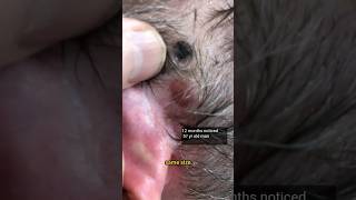 I Saw Black. I Thought Melanoma!