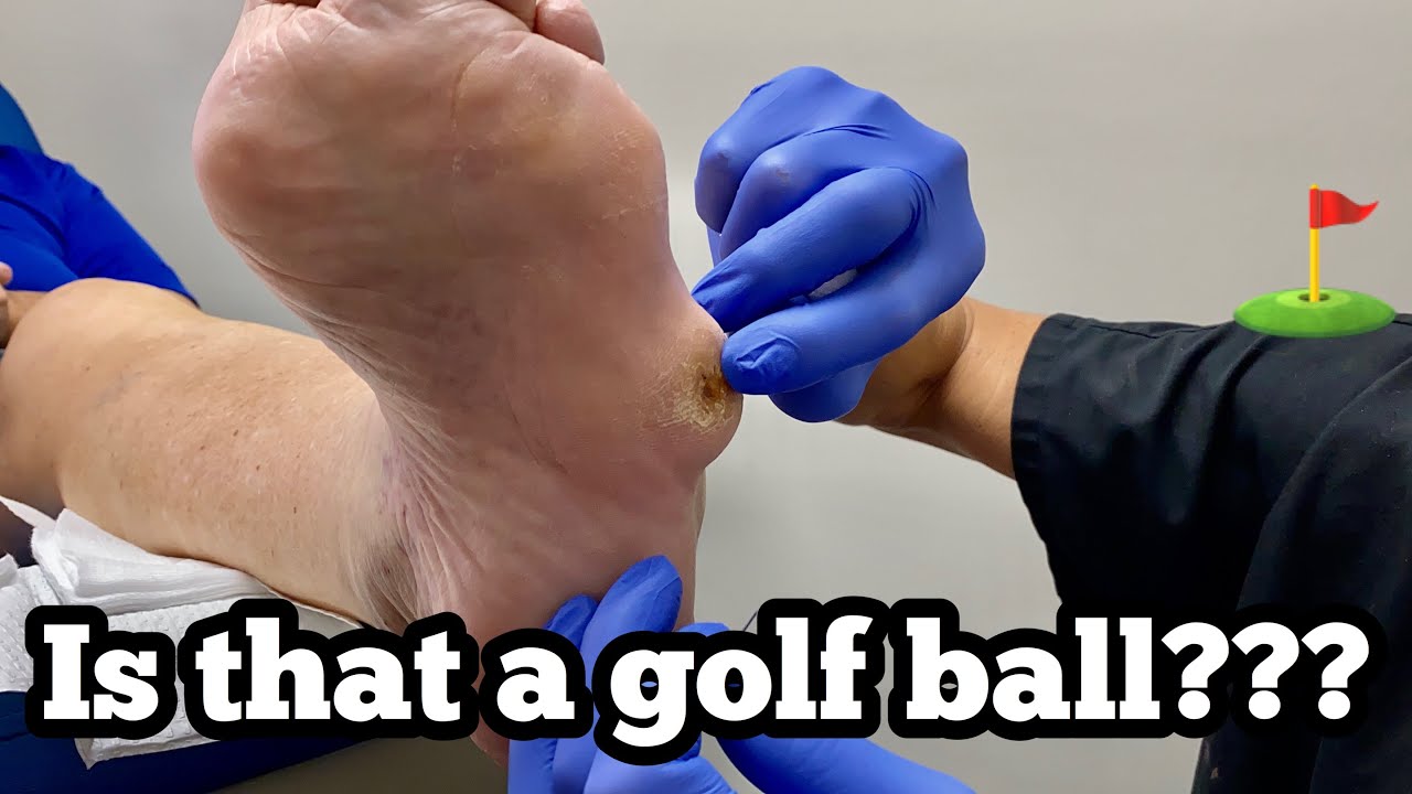 DEBRIDEMENT OF A HUGE BALL FROM THE FOOT