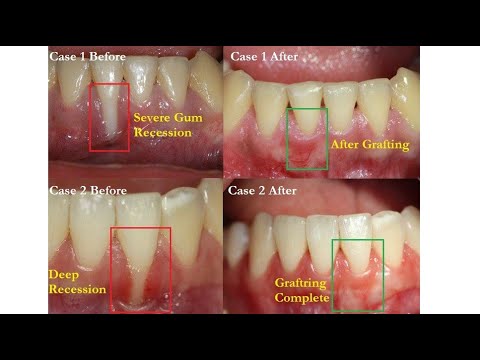 Gum grafting for gum recession is an amazing procedure that can replace rec...