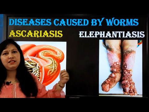 Ascariasis and Elephantiasis(Dieeases caused by worms)