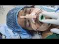 Man waking up after Surgery - Extubation Procedure