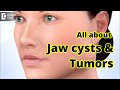 Jaw Cysts &amp; Tumors  Diagnosis &amp; Treatment - Dr. Girish Rao