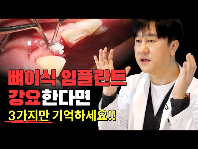 임플란트 뼈이식 사기당하지 않는 3가지 방법 | 뼈이식 임플란트 알고 하세요!!