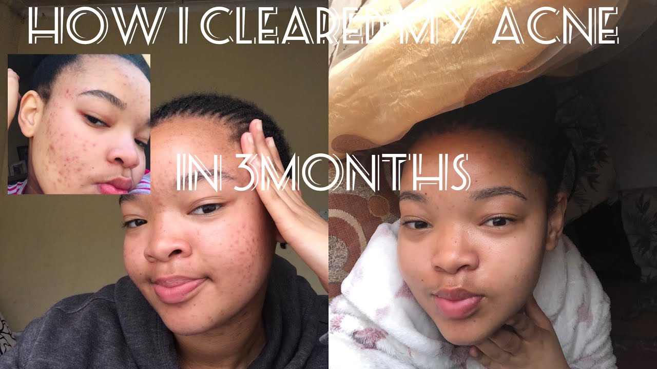 Part 1|HOW I CLEARED MY ACNE IN 3 MONTHS USING BENZAC | Lisakhanya ...