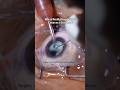 What Really Happens in Cataract Surgery?