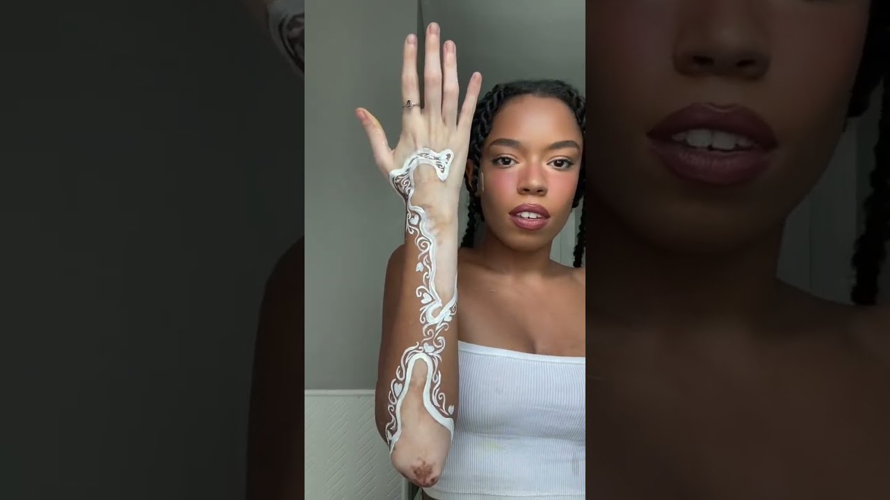 Vitiligo Wedding Idea