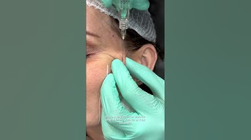 Look What Profhilo Structura Did to My Face!