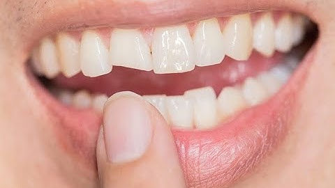 CÙNG BẠN SỐNG KHỎE (12/11): PHÒNG TRÁNH CÁC BIẾN CHỨNG KHI BỌC RĂNG SỨ