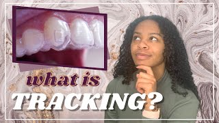 Invisalign 101: Tracking - what does it mean?