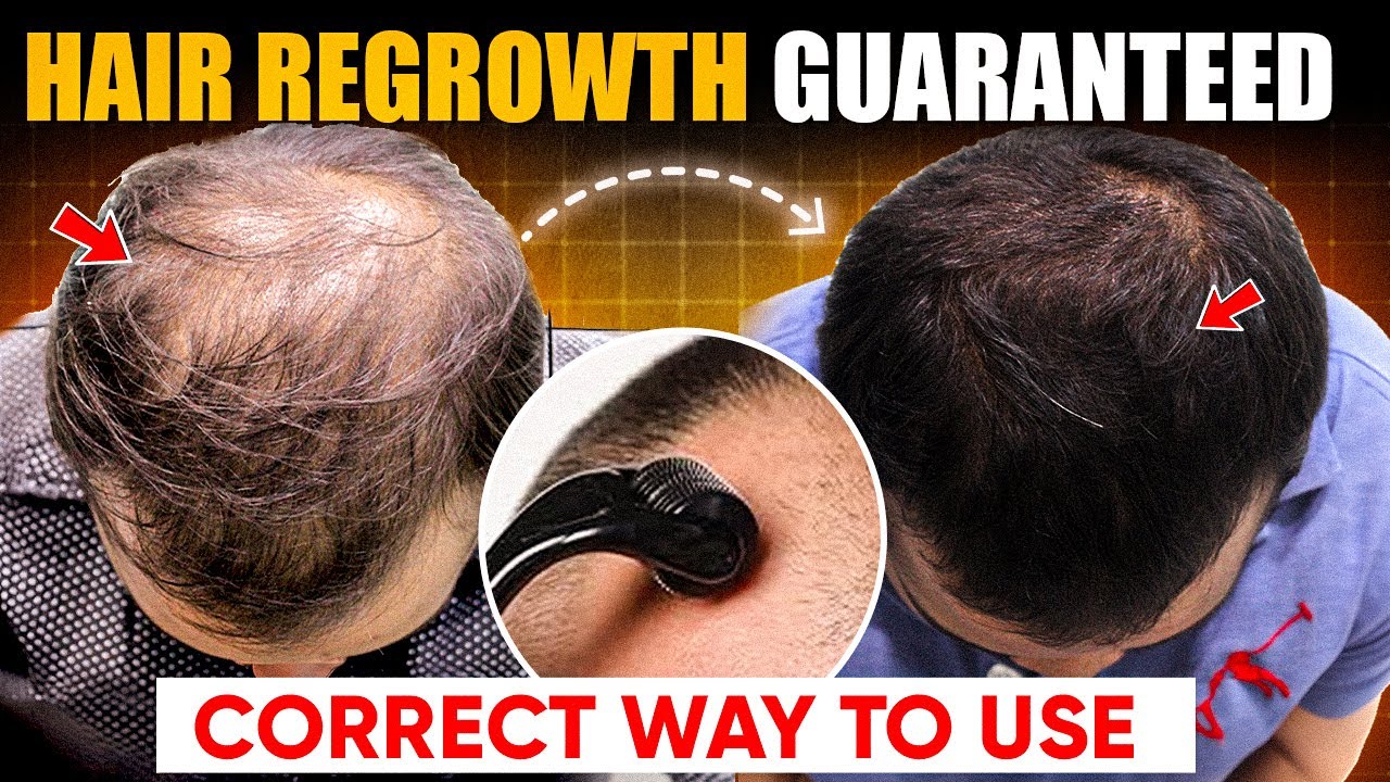 How to use Derma Roller on Hair | Derma Roller Hair Regrowth | Hair Fall Solution at Home