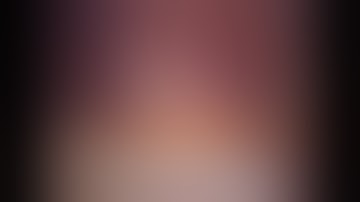 Laparoscopic Appendicectomy Case 1 - A 30yr old female with recurrent appendicitis!