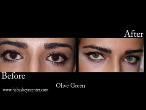 brightocular eye color change olive green by drsalman habash - Eye Color Change Surgery Before And After brightocular eye color change olive green by drsalman habash - Eye Color Change Surgery Before And After
