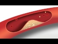 Blood Pressure Animation | Heart disease risk factors
