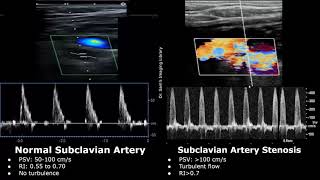 Subclavian Artery Doppler Ultrasound Normal Vs Abnormal Images | Stenosis & Steal Syndrome USG