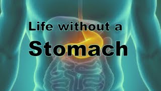 Can you live without a Stomach?