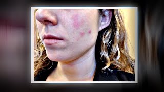 Can a Popular Diet Cause an Acne Breakout?