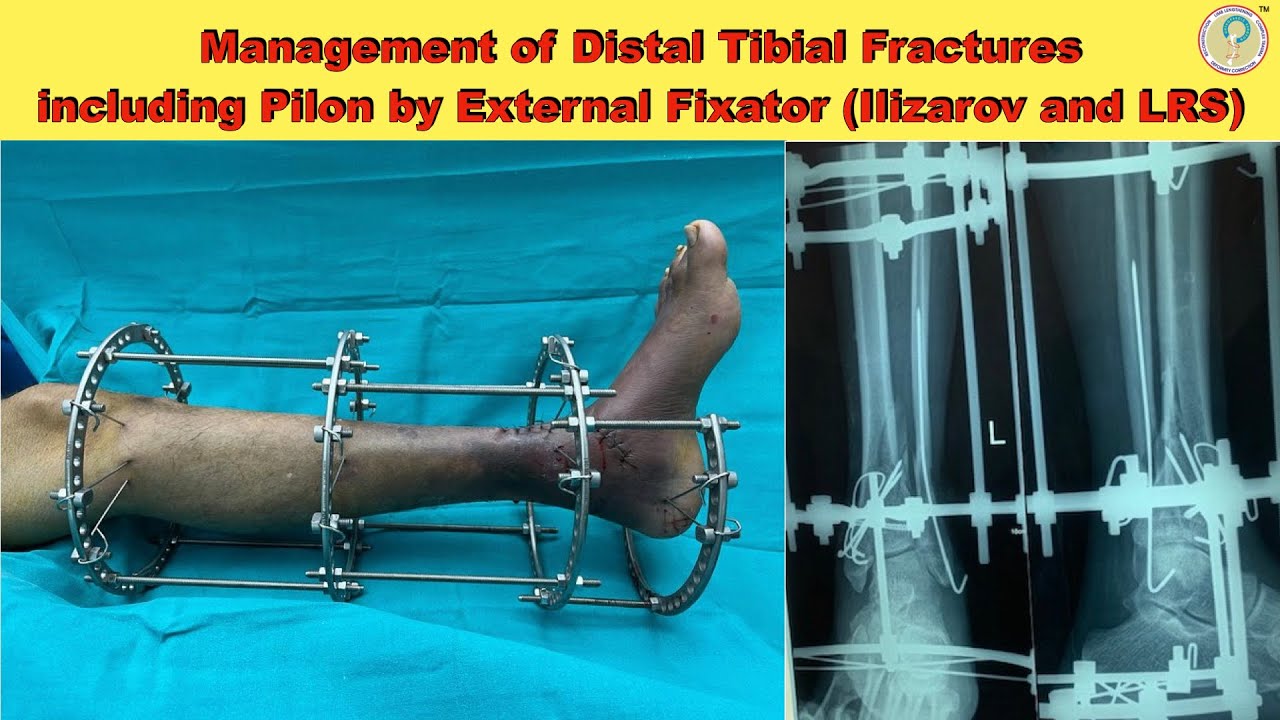 Management of Distal Tibial Fractures including Pilon by External ...