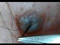 ほくろの毛を引っこ抜く！part8 Hair of a mole!