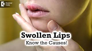 Swollen Lips: Common Causes,Triggers |  Angioedema  - Dr. Rashmi Ravindra | Doctors' Circle screenshot 2